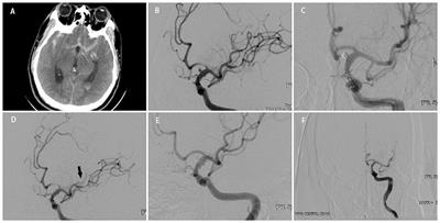 Safety and Efficacy of Endovascular Therapy for Blood Blister-Like Aneurysms: Willis Covered Stents and Double Stents Assistant Coils—A Single Center Cohort Study